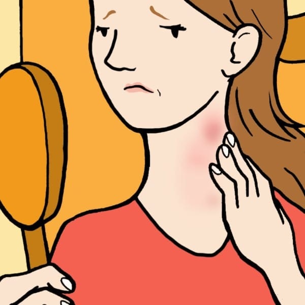 How To Get Rid Of A Hickey